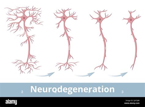 Neuronal Degeneration Stock Vector Images Alamy