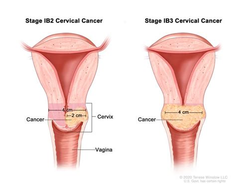 Cervical Cancer Treatment Pdq® Nci