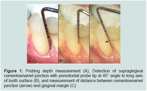 Avens Publishing Group Reproducibility Of Manual Periodontal Probing