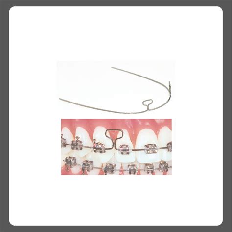 Truforce T-loop wire 16x22 , pk of 10 - SA Dental