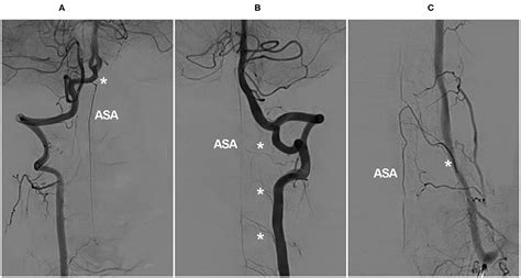 Anterior Cord Syndrome Vertebral Artery