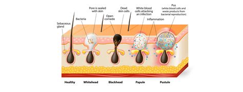 Формирование акне
