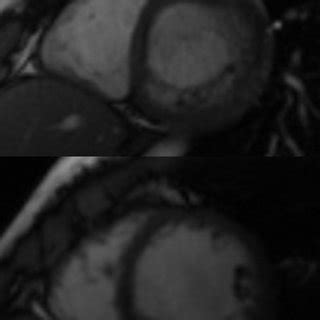 Cardiac Magnetic Resonance Images Suggesting Left Ventricular