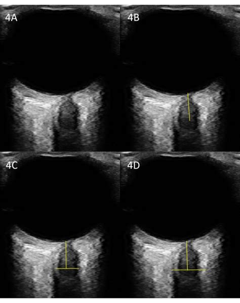 Optic Nerve Sheath Point Of Care Ultrasound Image Acquisition