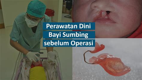 Bibir Sumbing Bayi Baru Lahir Butuh Perawatan Dini Dokter Bedah Mulut