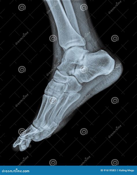 X-ray Ankle Joint AP Case Fracture Distal Metaphysis Of Distal Tibia
