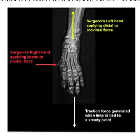 Figure From Conservative Treatment Of Transverse Metacarpal Fractures