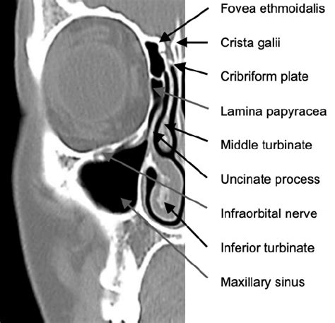 Ethmoid Lamina Papyracea On The Site