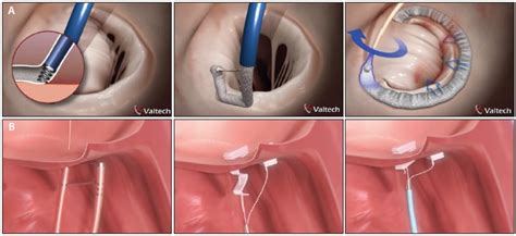 Percutaneous Mitral Valve Repair Devices Beyond Mitraclip Cardiac