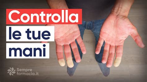 Sindrome Di Raynaud Sintomi E Cura YouTube