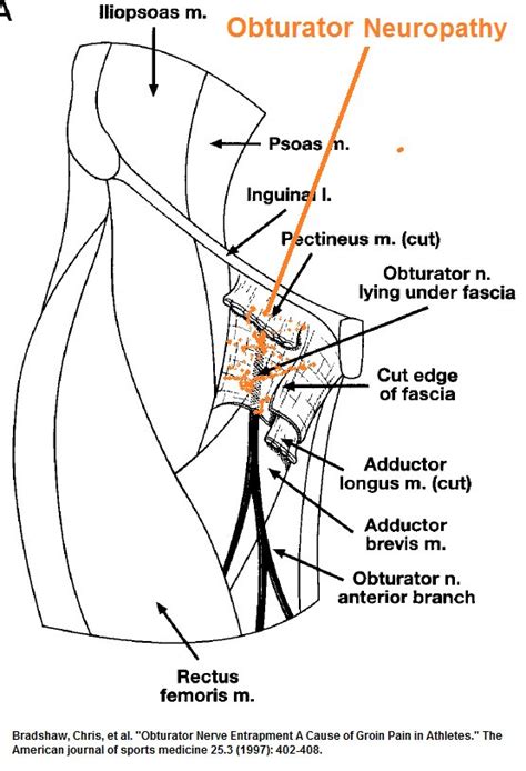 Groin Nerve Pain: Overview And Treatment Options | atelier-yuwa.ciao.jp