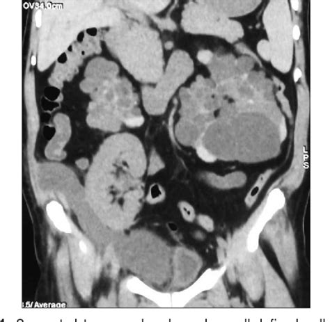 Figure 1 from Lymphocele complications following renal transplantation ...