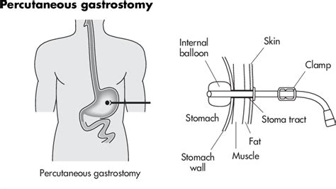 PDF Handbook Of Drug Administration Via Enteral Feeding Tubes