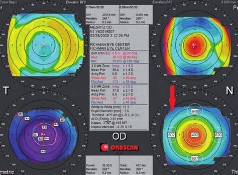 Corneal Maps Of Both The Anterior And Posterior Surface Of The Cornea