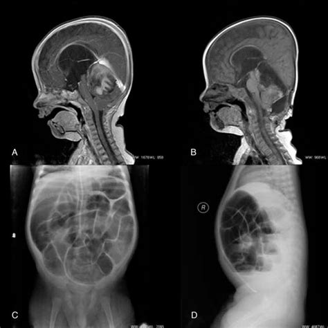 Case 1 A Preoperative Sagittal Contrast Enhanced T1 Weighted Download Scientific Diagram