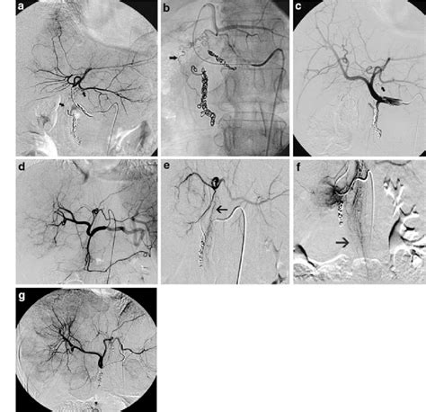 A Left Hepatic Arteriogram Demonstrates A Falciform Artery Arrows B