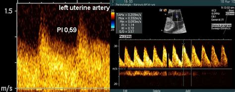 Normal Left Uterine Artery Flow Left Photo And Umbilical Artery Flow