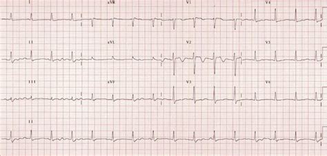 ECG Case 056 • LITFL • ECG Top 100 Self-Assessment Quiz