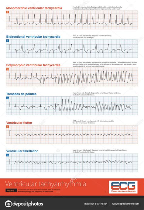 Ventricular Tachyarrhythmia Includes Many Clinical Types Some Benign