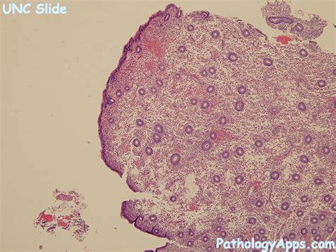 endometrial polyp pathology