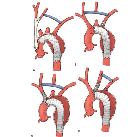 Carotid Subclavian Bypass