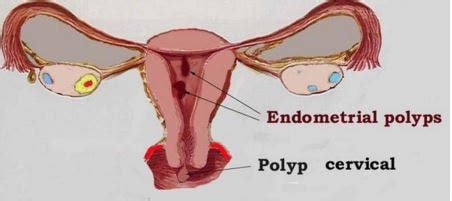 Cervical Polyp - Removal, Symptoms, Pictures, What is?