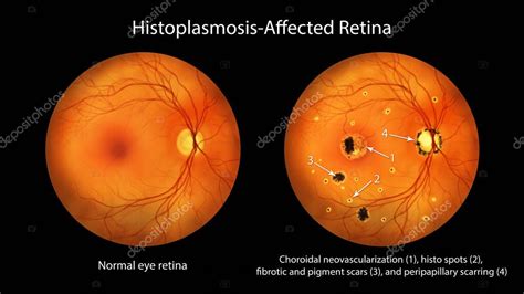 Retina en el Síndrome de Histoplasmosis Ocular Presunta como se observa