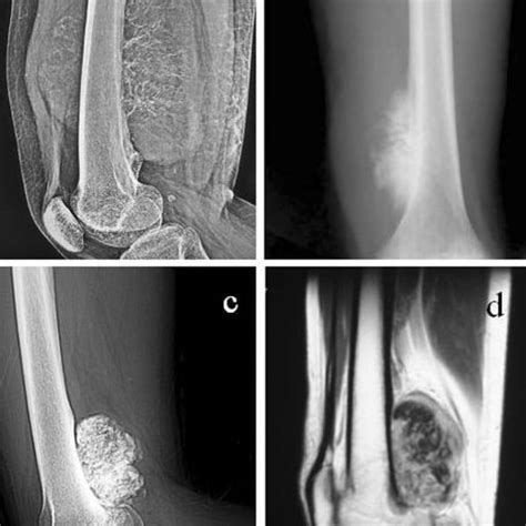 A Lateral Plain Film Of Case 1 With High Grade Bone Forming Sarcoma