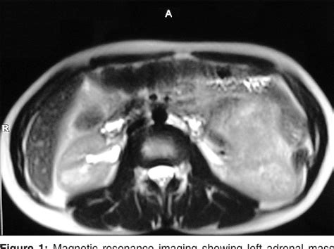 Figure 1 From A Case Series Of Two Cases Of Juxta Adrenal Schwannoma