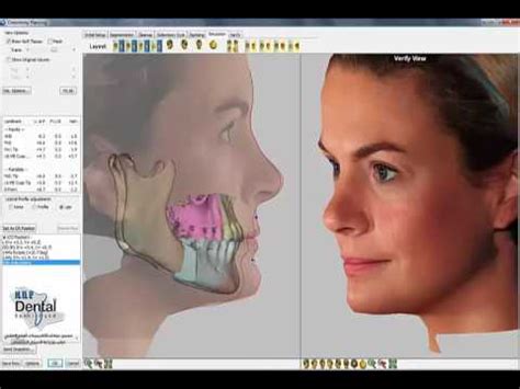 3D Visual Treatment Objective VTO Software Demo YouTube