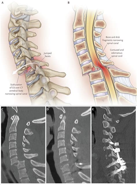 Acute Spinal Cord Compression New England Journal Of Medicine