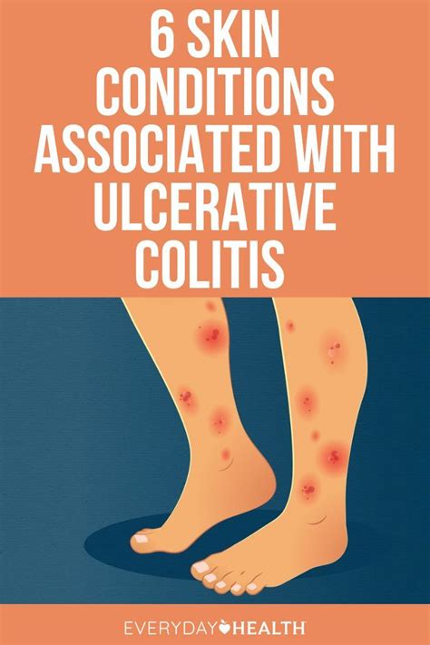 Skin Conditions Linked To Ulcerative Colitis Artofit