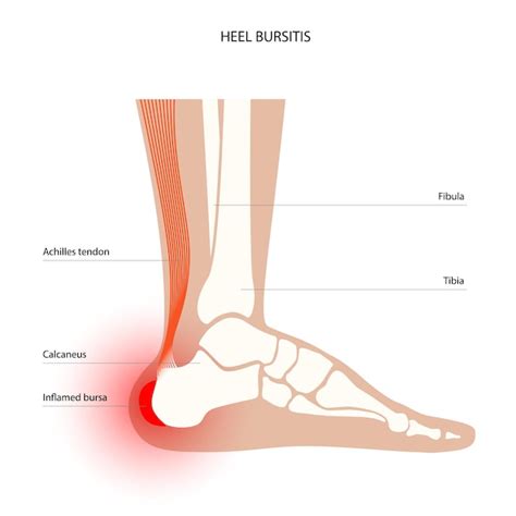 Premium Vector Bursitis Inflammation Concept