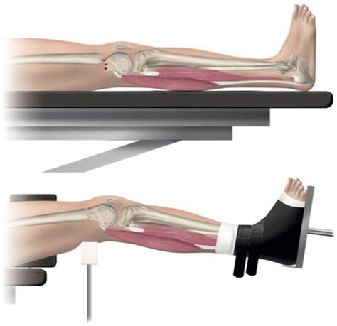 JCM Free Full Text Using A Traction Table For Fracture Reduction