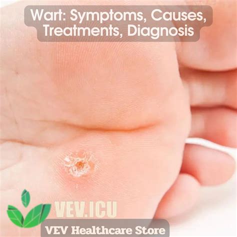 Wart: Symptoms, Causes, Treatments, Diagnosis