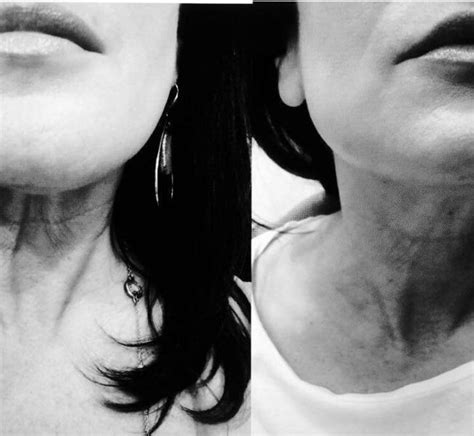 Neck Botox Pictures (2) » Facial Injections: Info, Prices, Photos ...