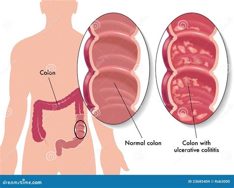 Ulcerative colitis stock vector. Image of chronic, ulcer - 23685404