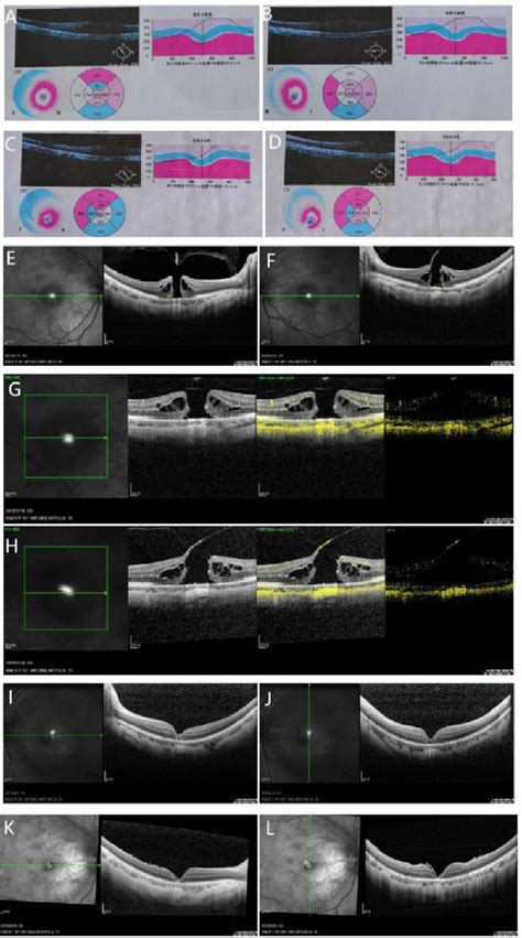 Bilateral Full Thickness Macular Hole Formation After Single Dose Of