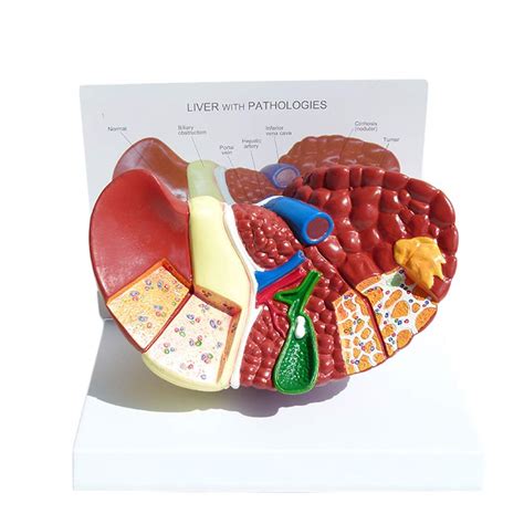 Buy DBSCD Liver Anatomical Model 3D Anatomical Pathological Liver