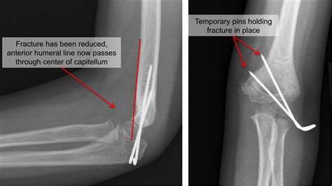 Kid's Elbow Fracture - Raleigh Hand Surgery — Joseph J. Schreiber, MD