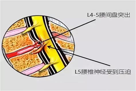 腰椎间盘突出不能自愈 勿侥幸拖延 八成保守治疗即可 腰间盘突出症 腰突 腰部 缓解 保养 健康界