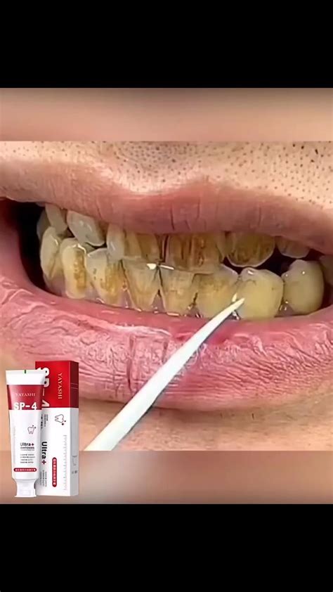 Oui Le Gingembre Et Le Sel Permettent De Blanchir Les Dents Voici