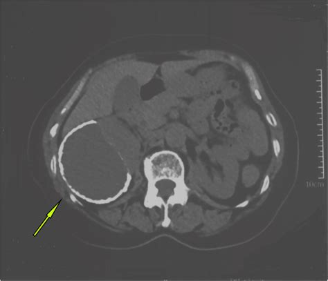 Ct Scan Showing The Annular Calcification Wall Around The Right Kidney