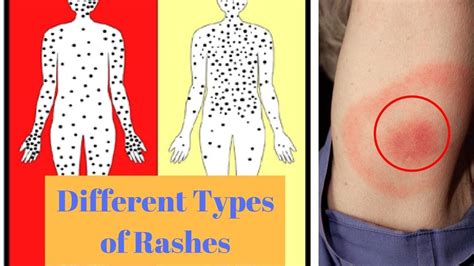 10 Common Rashes Skin Chart