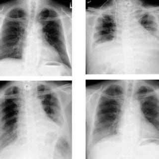 (PDF) Diaphragmatic plication in adult patients with diaphragm ...