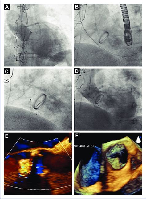 Step By Step Of Percutaneous Closure Of Aortic Paravalvular Leak