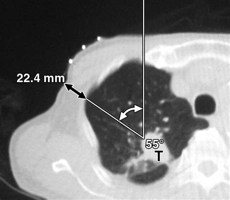 Ct Guided Core Biopsy Of Lung Lesions A Primer Ajr