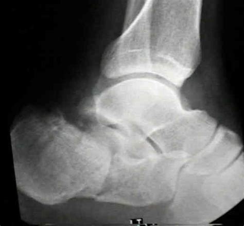 ORIF of Calcaneal Fractures : Wheeless' Textbook of Orthopaedics