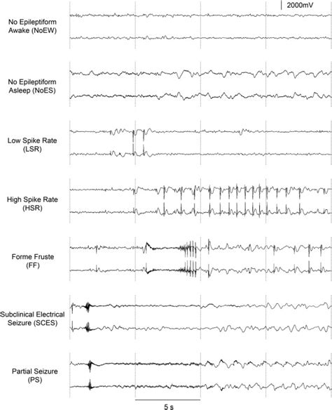 Improving Early Seizure Detection Epilepsy Behavior