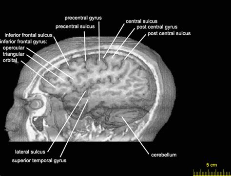 Sagittal level 1022 as MRI